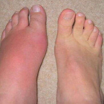 Articul&rsquo;R ou Muscul&rsquo;R ? La crise de goutte